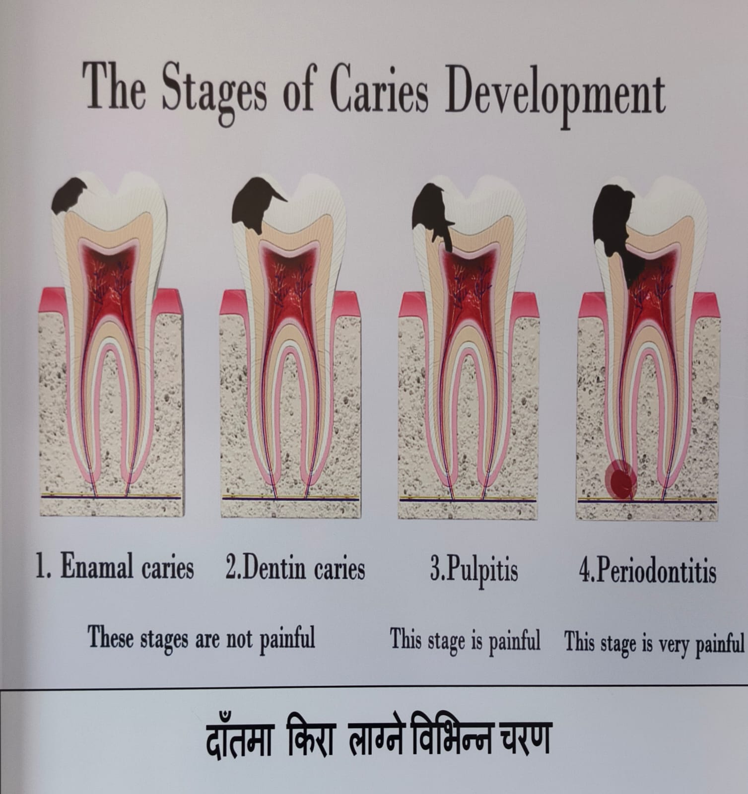 Stages of caries development